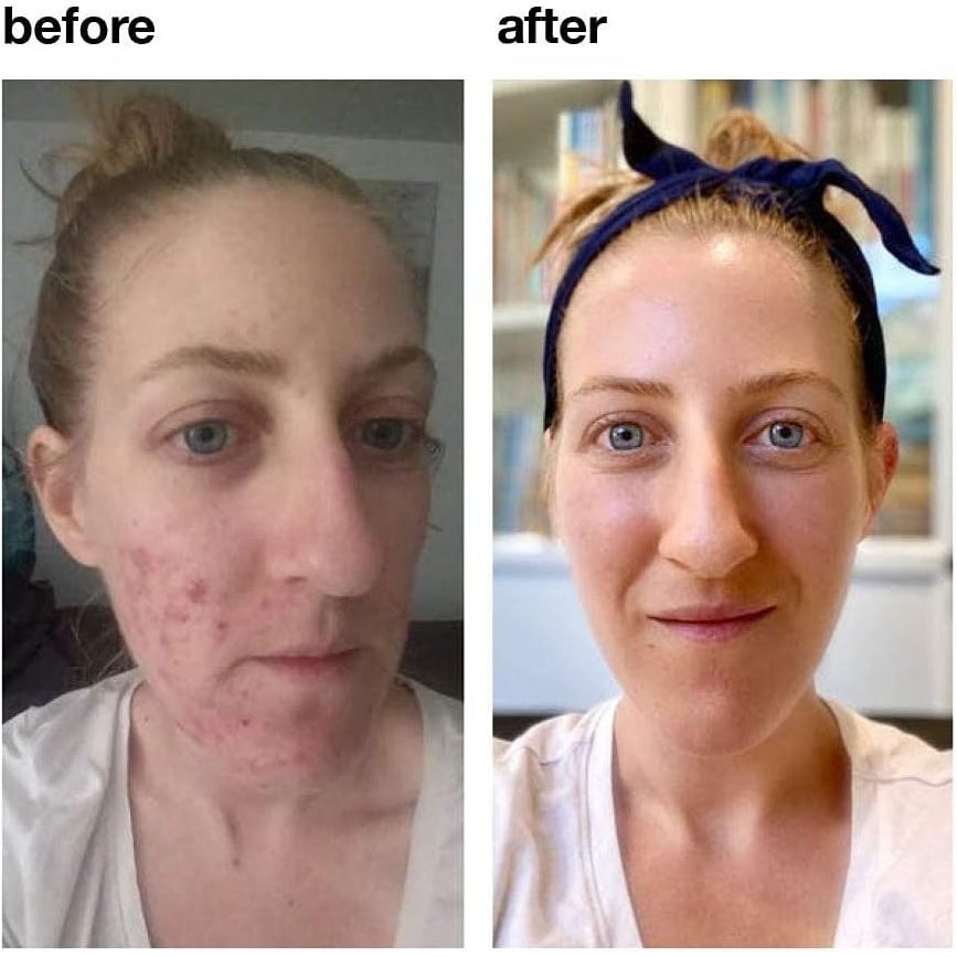 Vitamedica Clear Skin Vitamin Formula | Noncystic Acne Supplement for Skin Clearing 60 Count