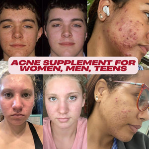 Acne Pills- Vitamin Supplements for Acne Treatment- Natural Clear Skin from Hormonal Cystic Pimples- 60 Tablets