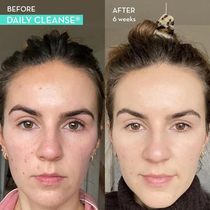 HUM Daily Cleanse Acne Supplement - Gut Cleanse Detox for Clear Skin (60 Capsules)